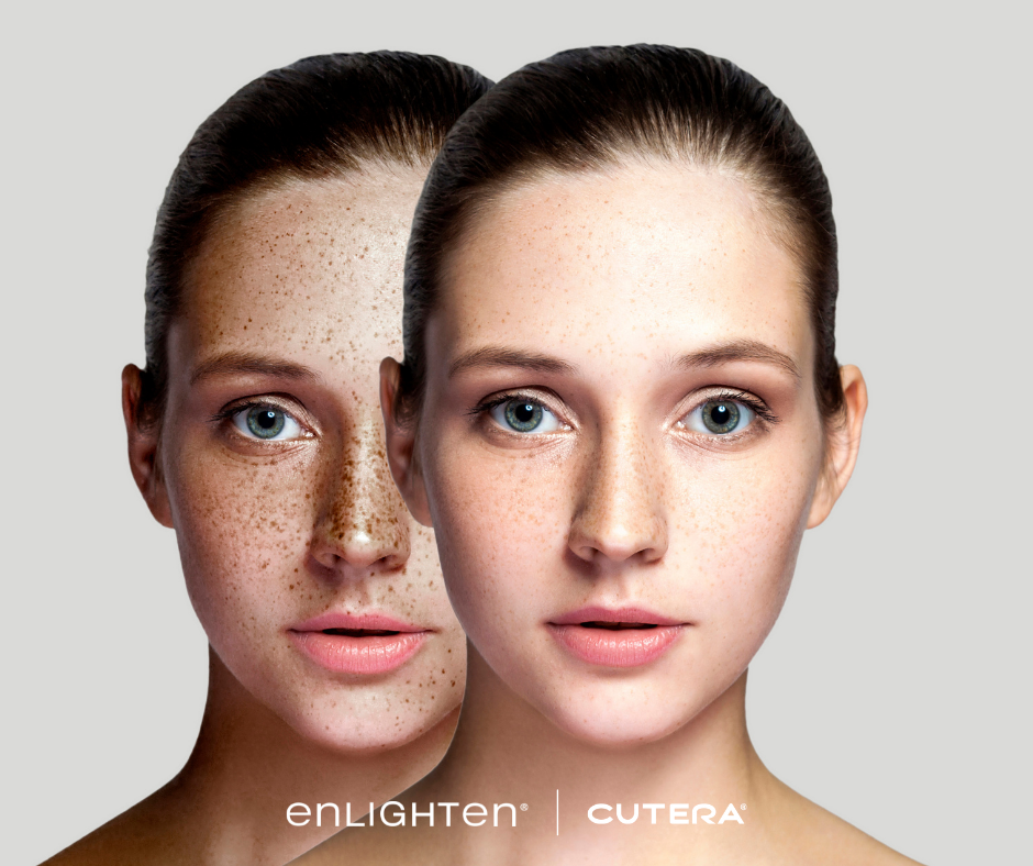 enlighten cutera for freckles and pigmentatoin